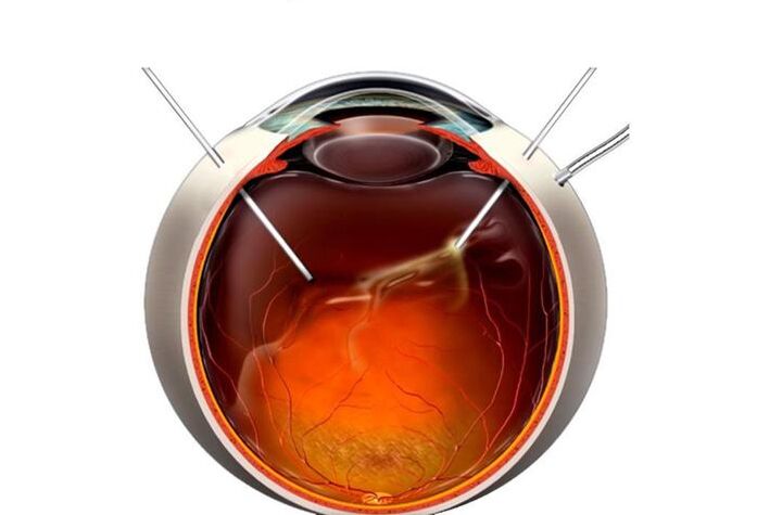VITRERECTOMY - the operation to restore vision